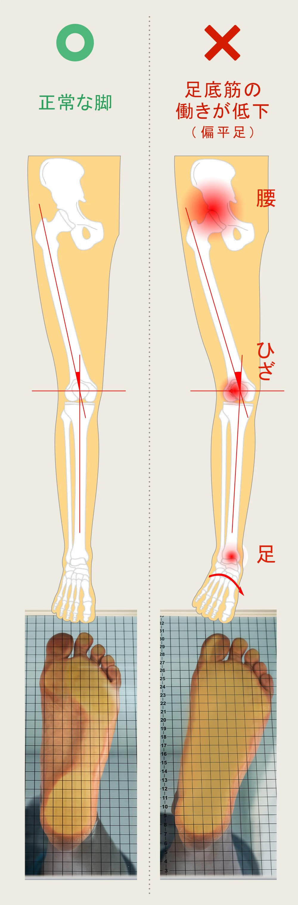 足底筋の働きが低下するとアーチ崩れに繋がり、膝や腰に影響が出る可能性があります