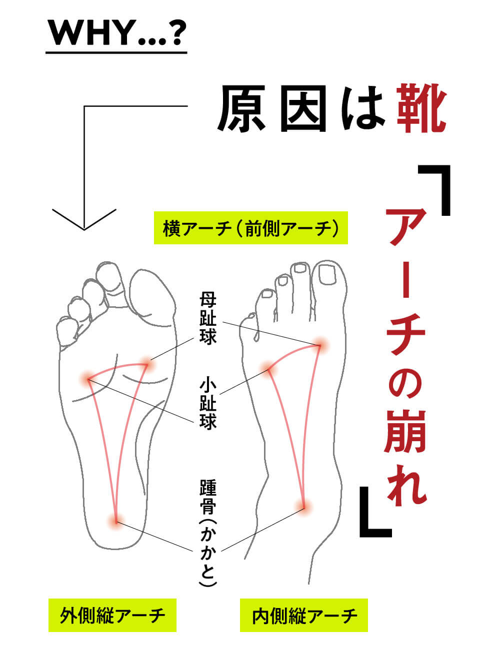 かかとの歪みとアーチの崩れ