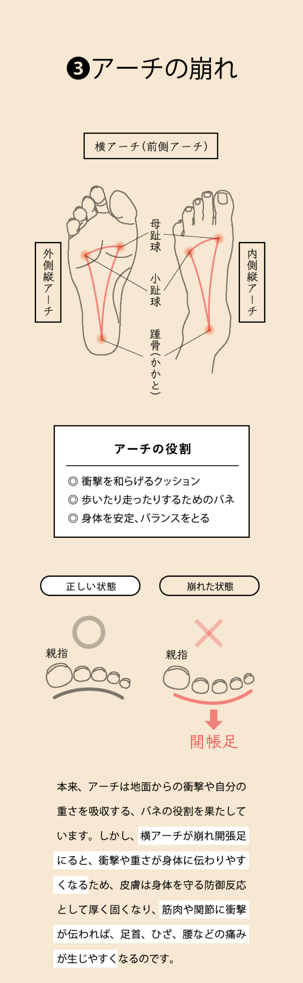 アーチの崩れ